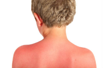 Council ordered to apologise after child hospitalised with sunburn image